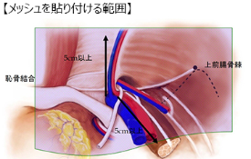 TEPP手術