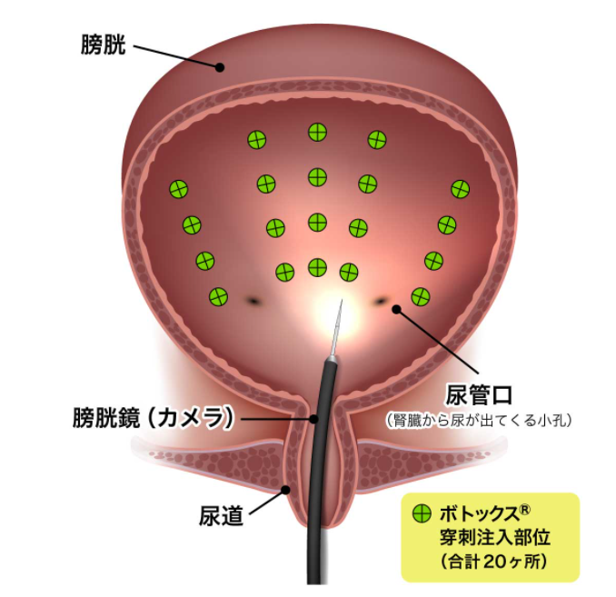 日帰りボツリヌス療法