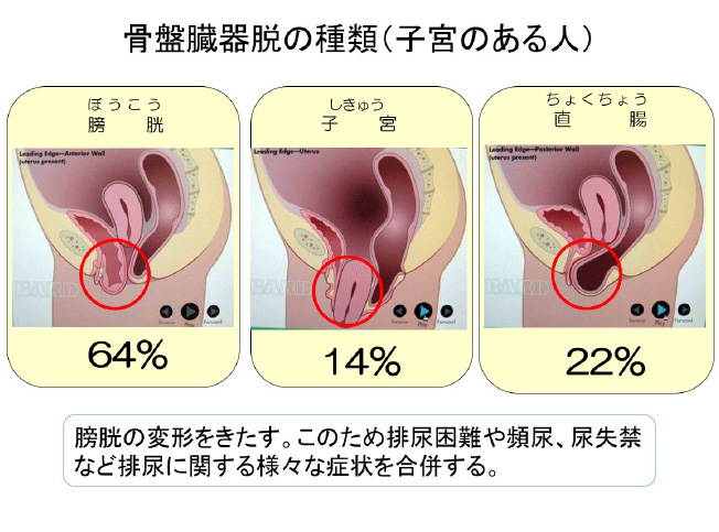 骨盤臓器脱の種類（子宮のある人）