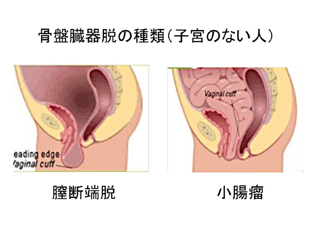 骨盤臓器脱の種類（子宮のない人）