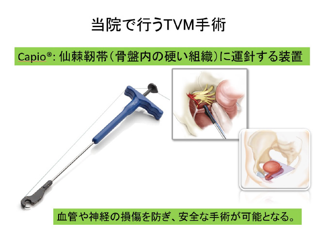 当院で行うTVM手術