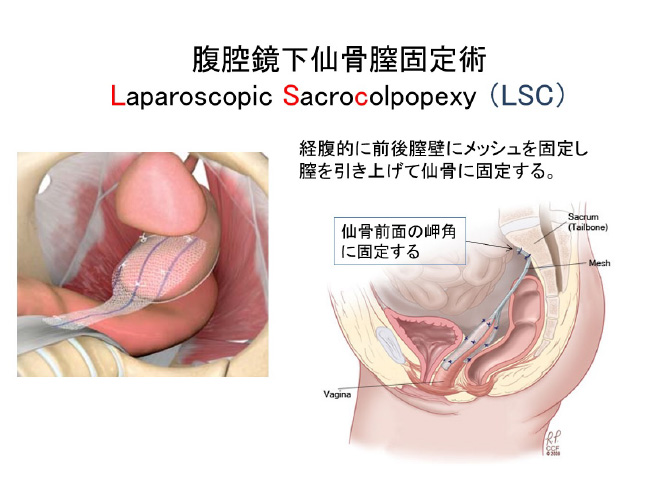 腹腔鏡下仙骨膣固定術